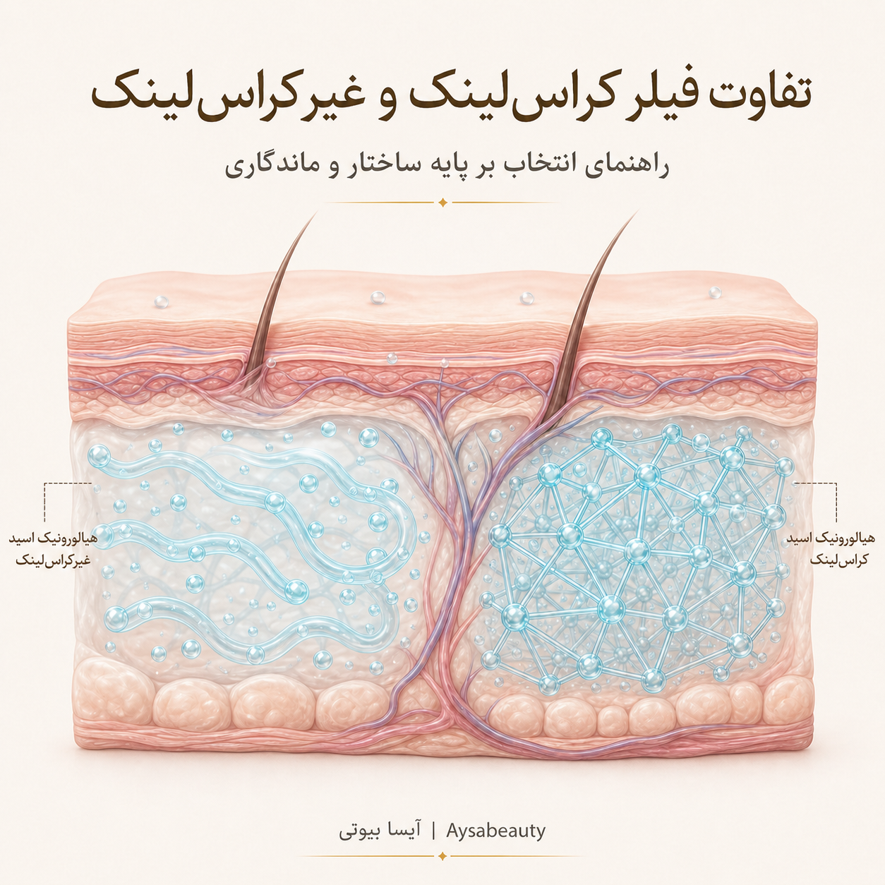 راهنمای جامع تفاوت فیلرهای کراس‌لینک و غیر کراس‌لینک؛ کدام برای شما مناسب‌تر است؟